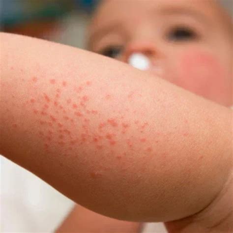 Baby Skin Rashes: Causes, Symptoms & Treatment