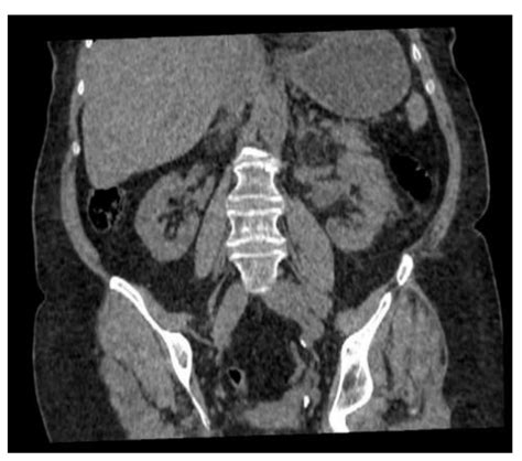 Ureteric Stone-Related Escherichia coli Bacteraemia Associated with ...