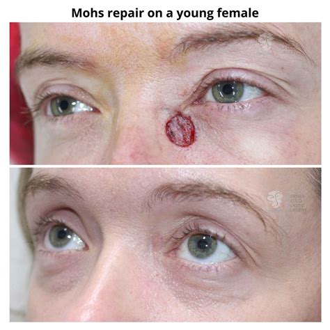 How Long Does Swelling Last After Mohs Surgery On Face