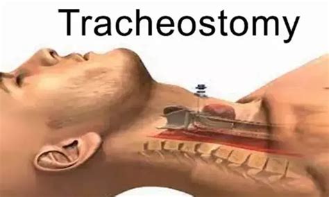 Tracheostomy within four days of intubation tied to lower short-term ...