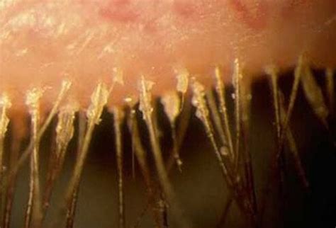 Bildergebnis für blepharitis ansteckend