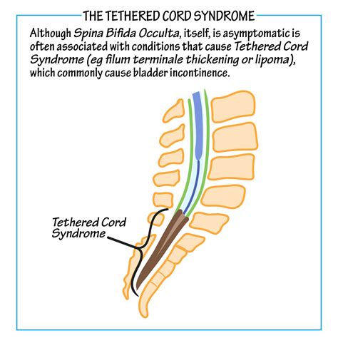 Neuroanatomy Glossary: Tethered Cord Syndrome | ditki medical & biological sciences
