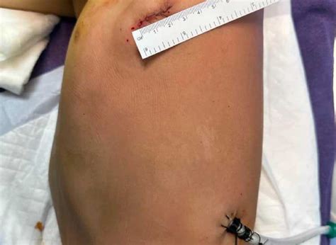 Thoracic & Muscle-Sparing Thoracotomy | Yashoda Hospitals