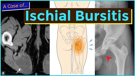Ischial Bursitis - MedEd Cases