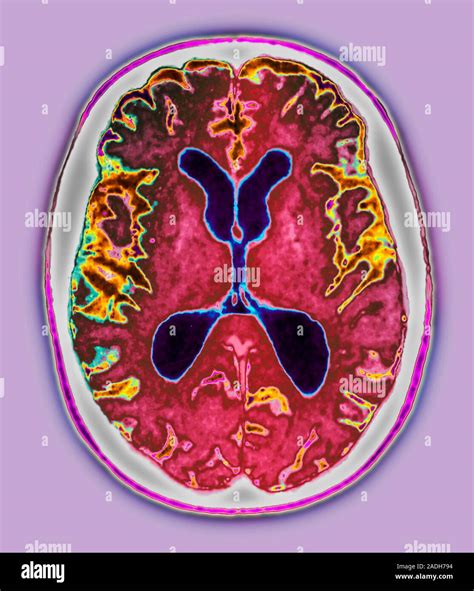 Alzheimer's disease. Coloured axial magnetic resonance imaging (MRI) scan of the brain of a 65 ...