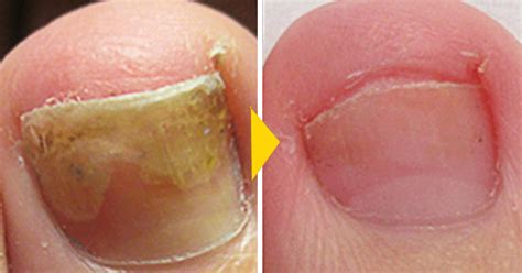 The best toenail fungus treatment for 2026, according to dermatologists Aesthetic