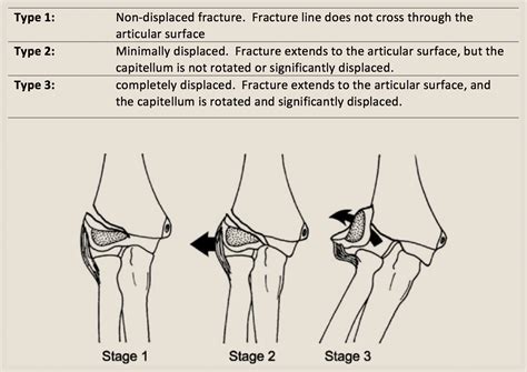 Elbow Grease Lateral And Medial Condyle Fractures Of - vrogue.co