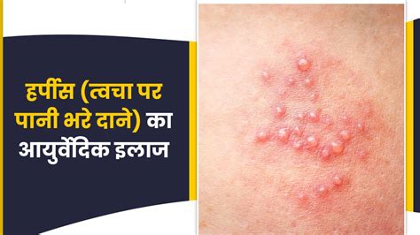 हर्पीस (त्वचा पर पानी भरे दाने) का आयुर्वेदिक इलाज | Ayurvedic Remedies ...