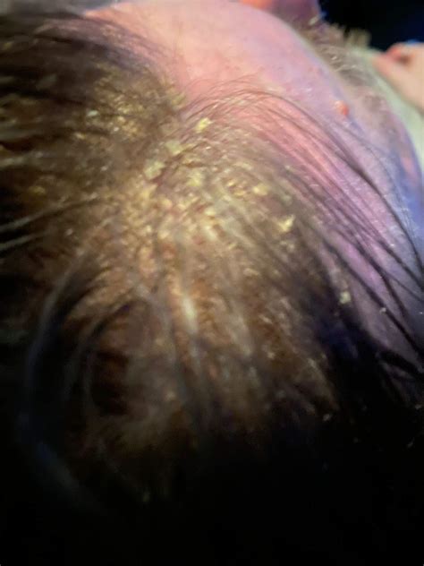 Scalp issues & how to resolve them | MUVO