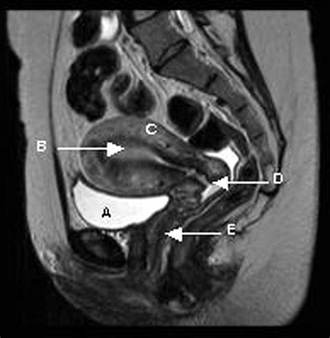 Mri Anatomy Female Pelvis at Martin Huey blog
