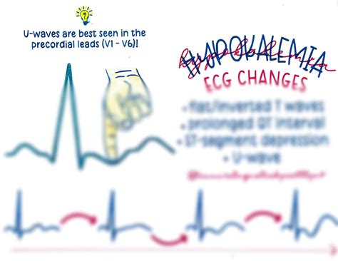 Hypokalemia & Hyperkalemia EKG Changes - Etsy