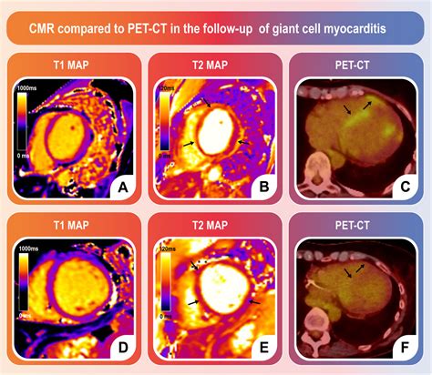 Breaking Expectations - CMR and PET-CT in Giant Cell Myocarditis Remission – a Comparative ...