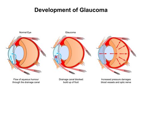 Why Ophthalmologists Look for Signs of Glaucoma