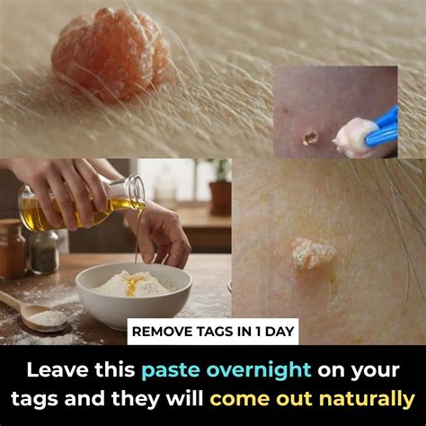 Best Natural Home Remedies To Safely Remove Skin Tags