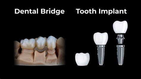 Dental Bridge Vs Implant: Which Tooth Replacement Option Is Right For You? | Smile Now Denver ...