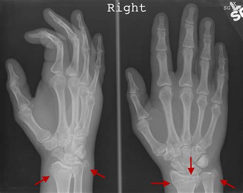 Ulnar Styloid Process Fracture X Ray at Agnes Hendricks blog