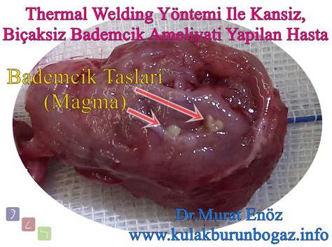 Tonsil Stone - Definition, Symptoms and Treatment