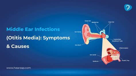 Middle Ear Infections (Otitis Media): Symptoms & Causes