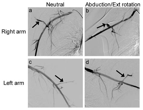Quadrilateral Space Syndrome: Diagnosis and Clinical Management