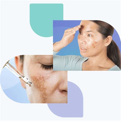 Guía dermatológica: Cremas y tratamientos para el melasma
