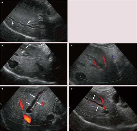 Feline abdominal ultrasonography: what’s normal? what’s abnormal? The biliary tree - Sally ...