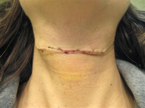 Cyst Trunk Operation