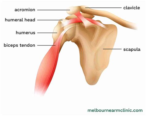 Bicep Tendon Tear at the Shoulder – Melbourne Arm Clinic