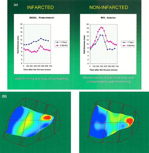 Left Ventricular Remodeling After Myocardial Infarction | Circulation