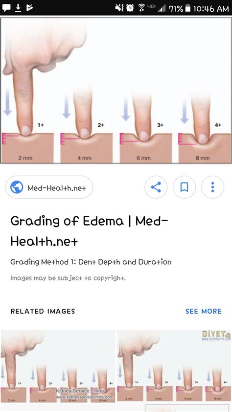 Pedal Edema Scale at John Rosado blog