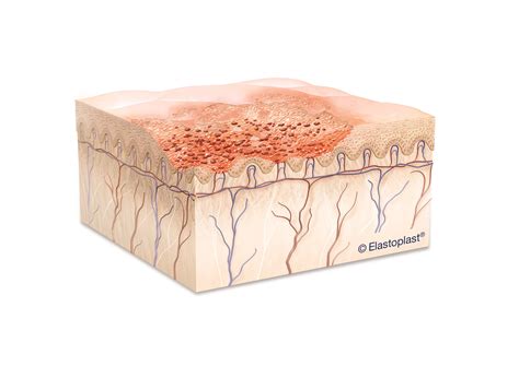 Friction Burns: Causes, Treatment and Care | Elastoplast UK