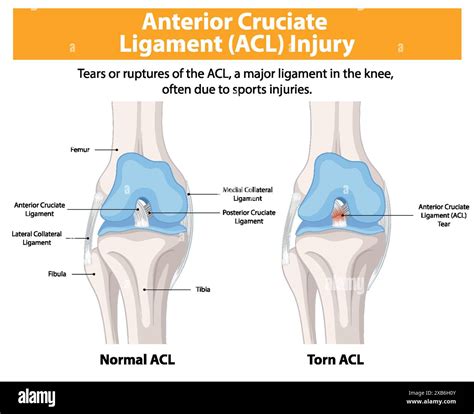 Comparison of normal and torn ACL in the knee Stock Vector Image & Art ...