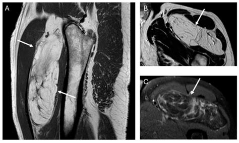 Differentiation of Atypical Lipomatous Tumors from Lipomas: Our Experience with Visual Analysis ...
