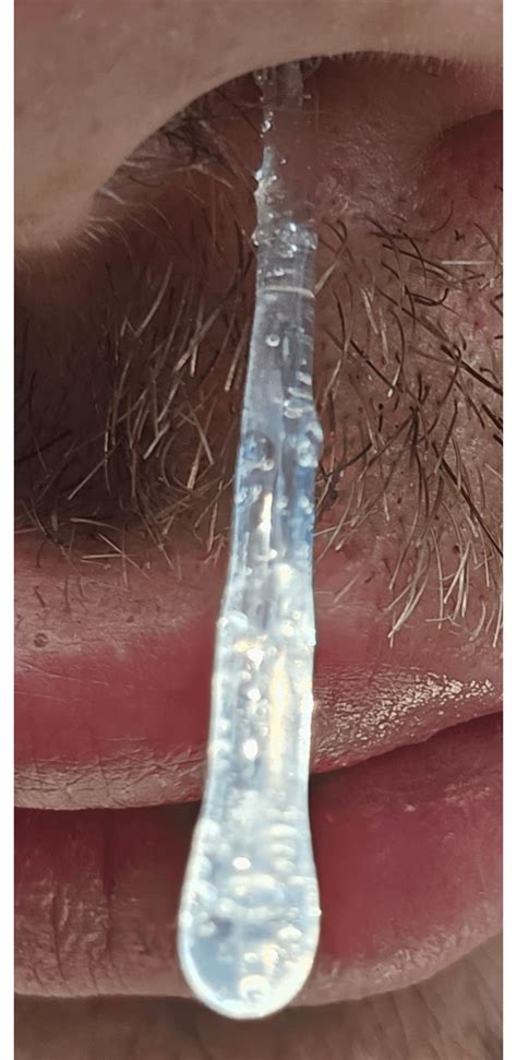 Does this look like CSF? : r/CSFLeaks