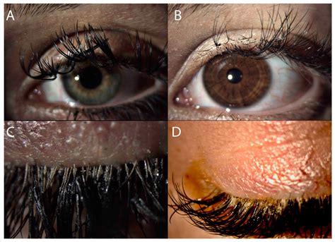 Beauty versus Health—How Eyelash Extensions May Affect Dry Eye Disease?