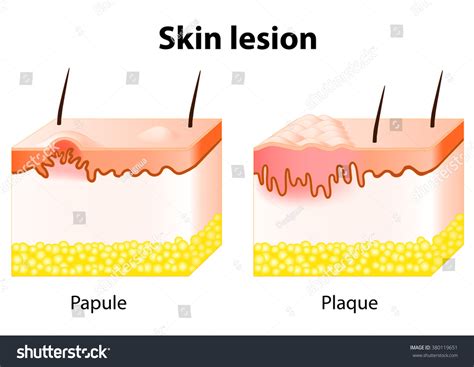 Skin Lesion. Papule Is A Solid Elevation Of Skin And Accumulation Of Material In The Dermis With ...
