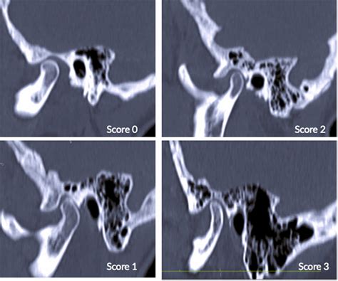 Communication between the temporomandibular joint articular space and ...