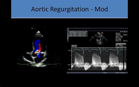 Stenosis Vs Regurgitation