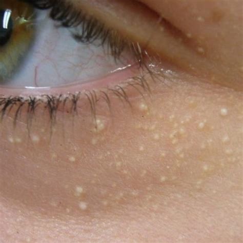 Fatty Deposits Around Eyes