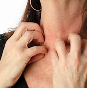 Image result for Fibromyalgia Rash Symptoms