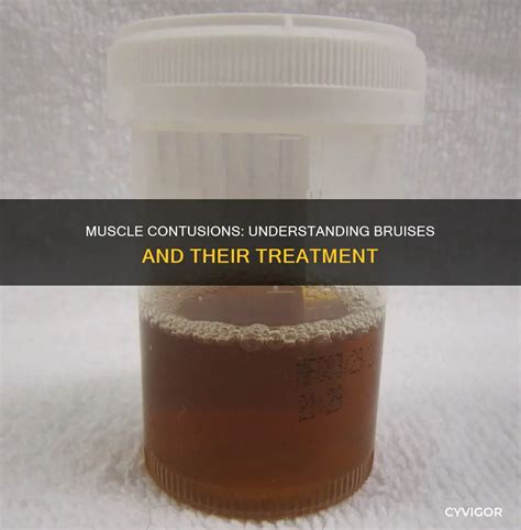 Muscle Contusions: Understanding Bruises And Their Treatment | CyVigor