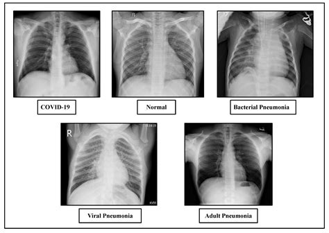 How To Read A Chest X Ray For Pneumonia at Evelyn Mcelroy blog