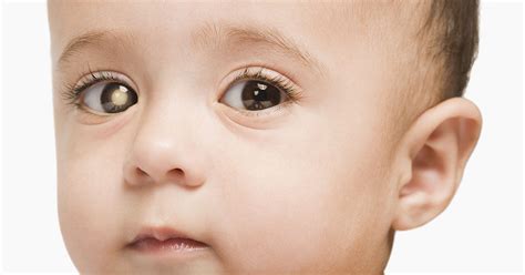Genetic Risk Factors and Clinical Outcomes in Childhood Eye Cancers: A ...