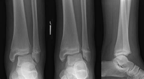 Salter Harris Type 1 Fracture Distal Fibula | My XXX Hot Girl