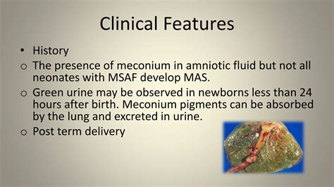 Meconium stained amniotic fluid aspiration syndrome | PPTX