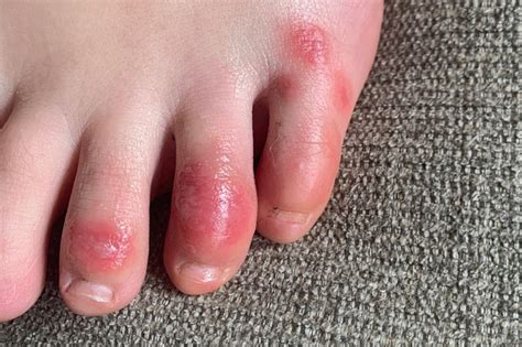 'COVID toes,' other rashes latest possible rare virus signs | Inquirer News