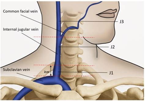 Ultrasound Evaluation of Internal Jugular Venous Insufficiency and Its ...