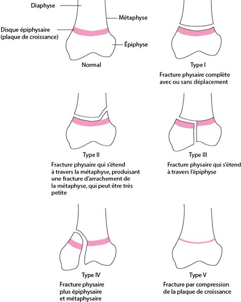 Image:Classification de Salter-Harris pour les fractures-décollement des disques ou plaques ...