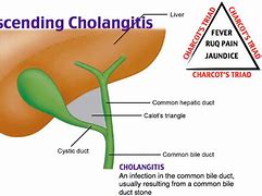 cholangitis 的图像结果