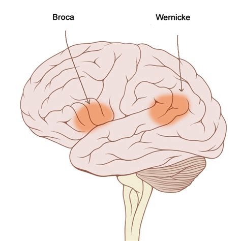 Afasia De Wernicke Afasias De Broca Y Wernicke. Regla Mnemotécnica.