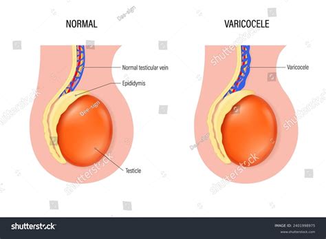 Testicular: Más de 1,734 ilustraciones y dibujos de stock con licencia libres de regalías ...